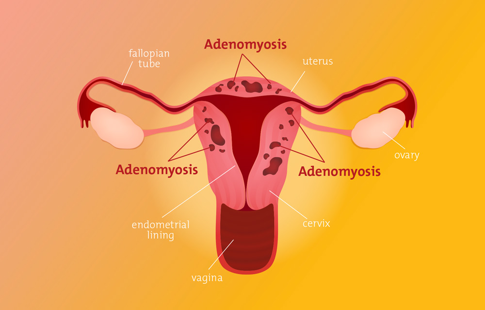 Diagram of adenomyosis