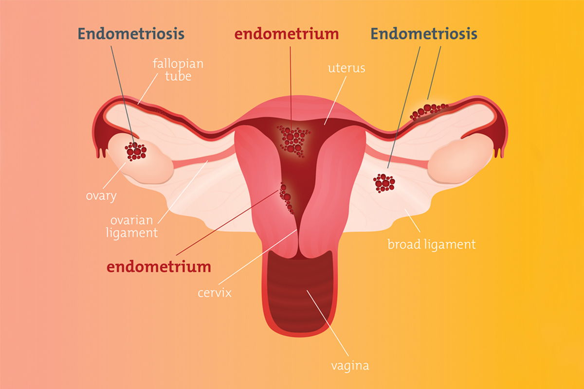 Diagram of endometriosis 
